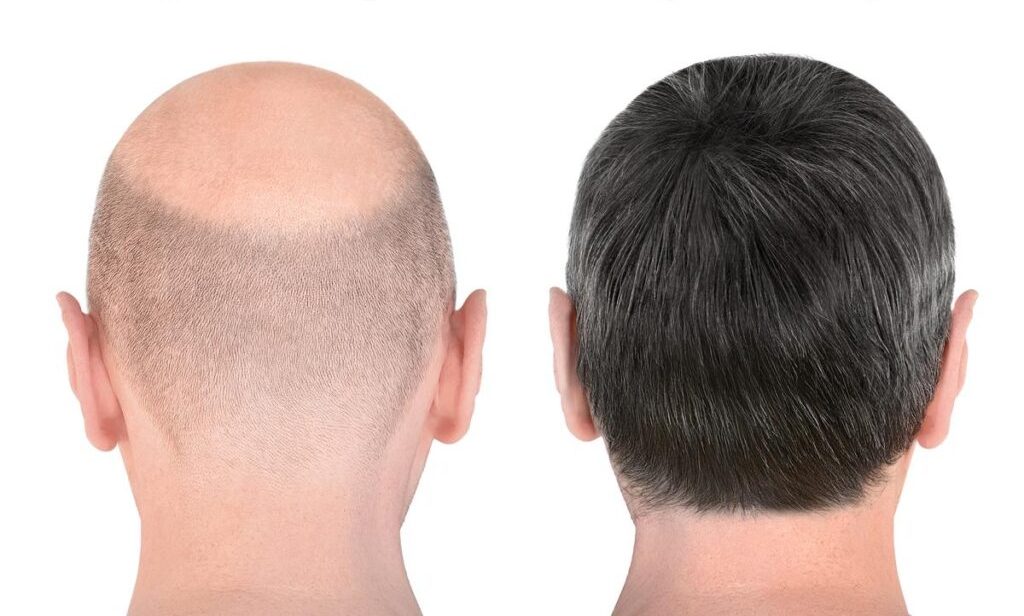 Male Hairtransplant Before After