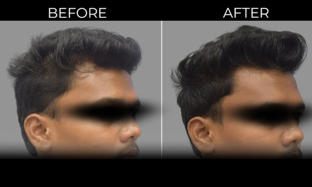 PRP Therapy Before After